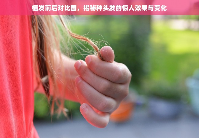 植发前后对比图，揭秘种头发的惊人效果与变化